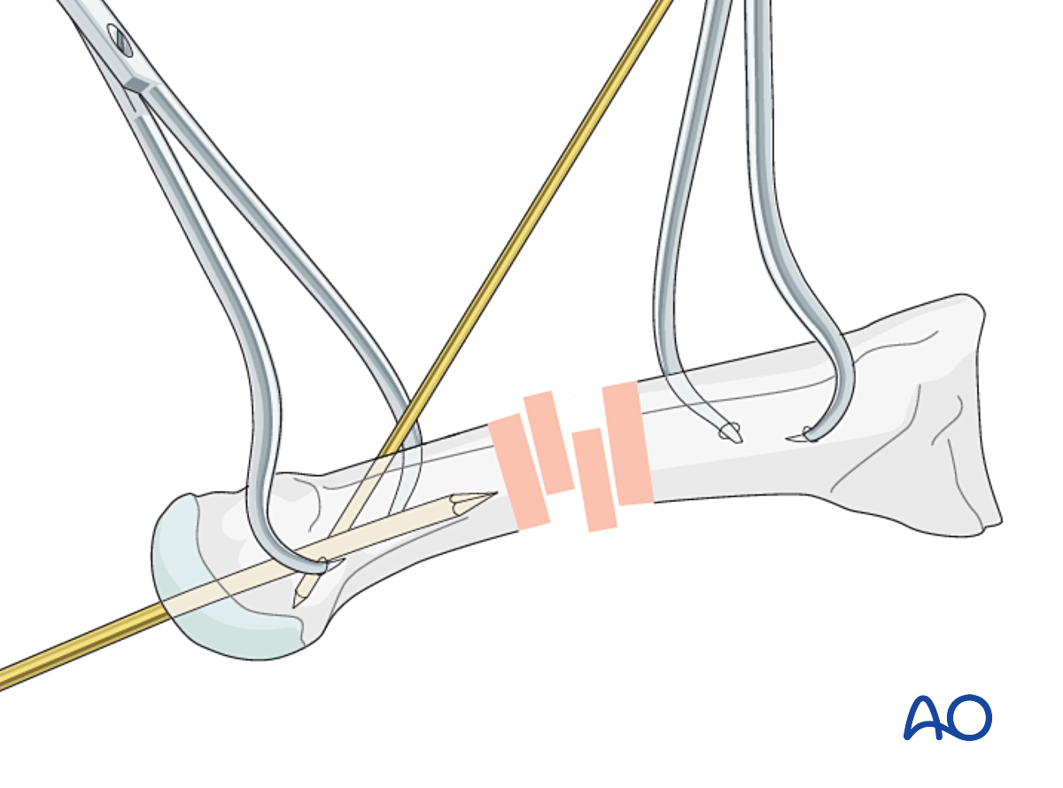 Intramedullary K-wire Fixation For Distal Extraarticular Fractures Of ...