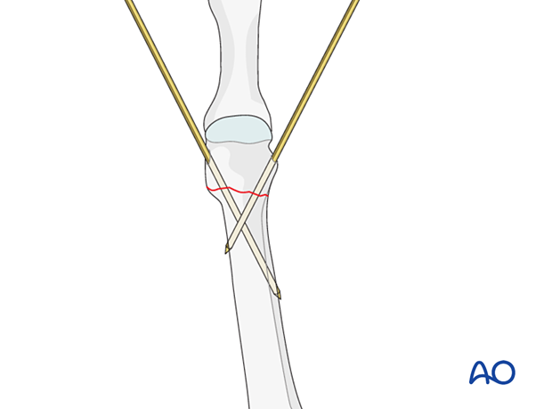 K-wire fixation of a distal extraarticular fracture of a metatarsal