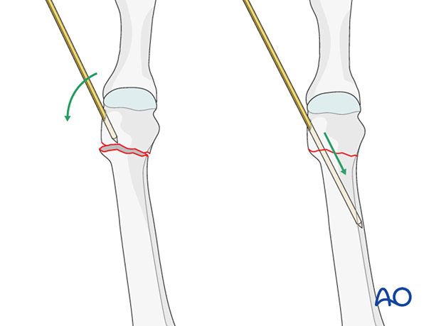 K-wire joystick reduction of a distal extraarticular metatarsal fracture