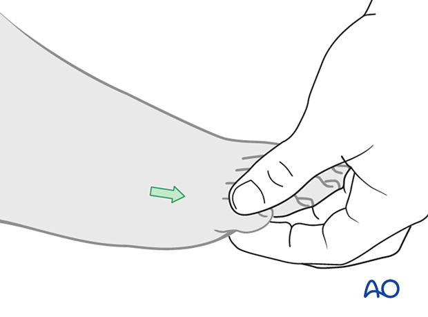 Indirect reduction of a distal extraarticular fracture of the 5th metatarsal