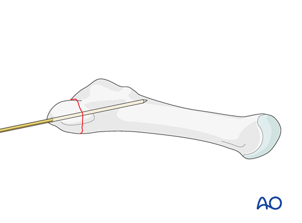 Preliminary fixation with K-wires of an avulsion fracture of the proximal 5th metatarsal