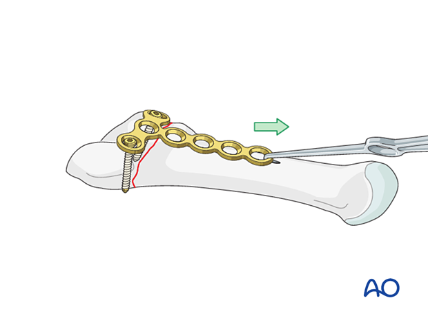 Fracture compression for plating of an articular fracture of the proximal 5th metatarsal