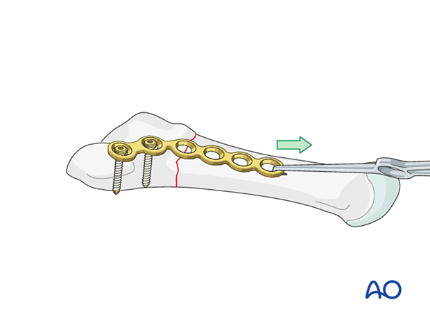 Fracture compression for plating of an extraarticular fracture of the proximal 5th metatarsal