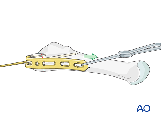 Compression plating of an avulsion fracture of the proximal 5th metatarsal