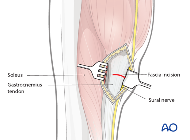 Release of the gastrocnemius equinus