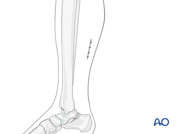 Wound closure after release of the gastrocnemius equinus