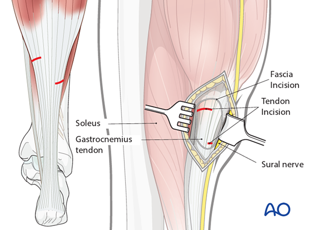 Release of the gastrocnemius equinus