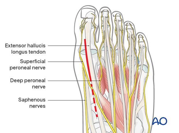 Incision line