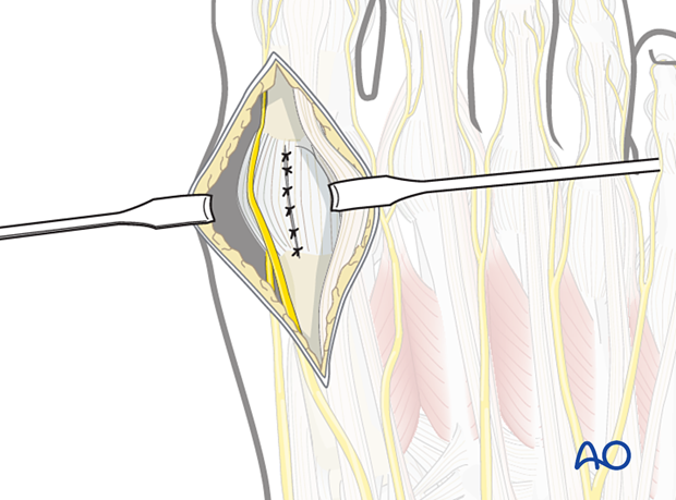 Closure of the joint capsule