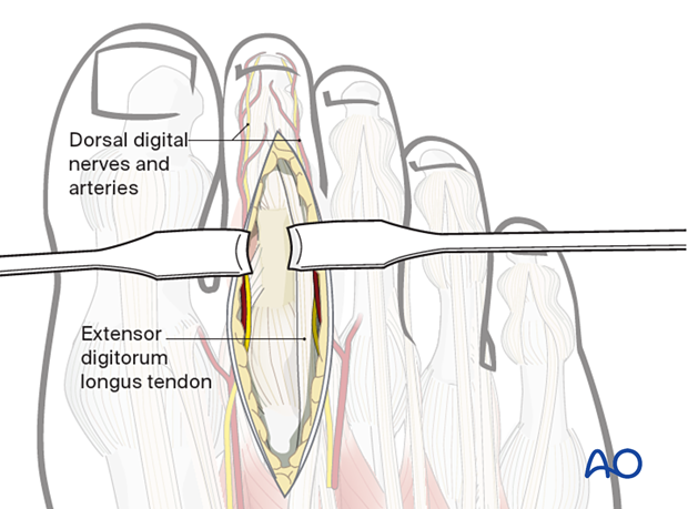 A020 dorsal approach to the proximal phalanx