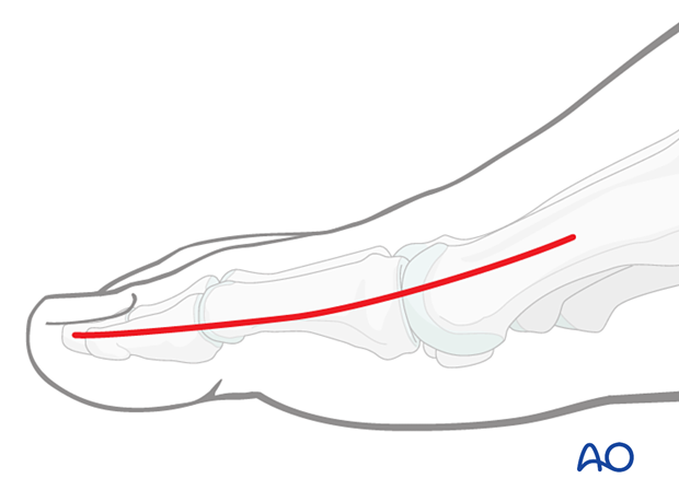 Medial approach to the hallux