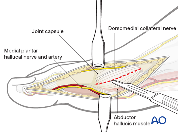 A030 medial approah to the hallux