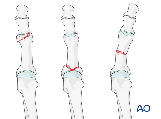 Fracture patterns