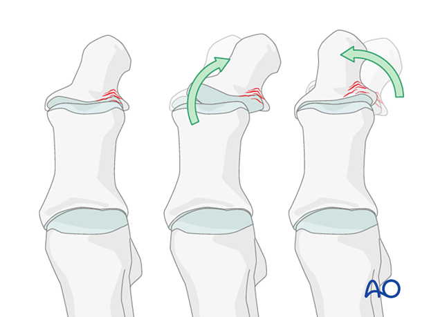 Fracture reduction