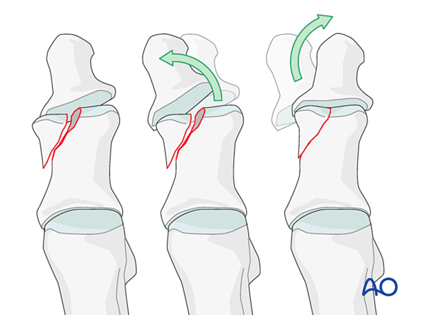 Fracture reduction