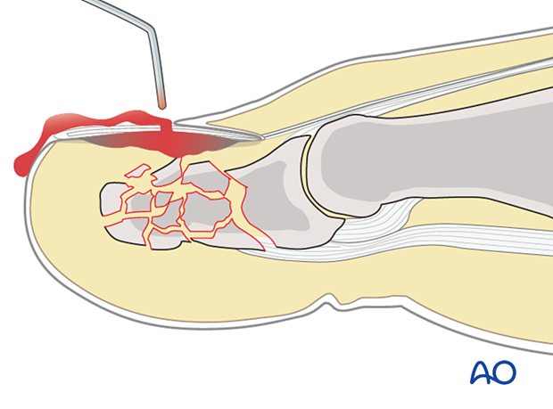 Release of subungual hematoma