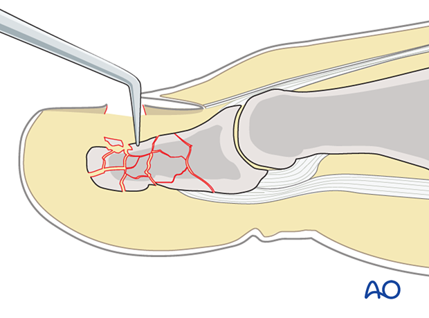 Reduction of displaced bone fragments