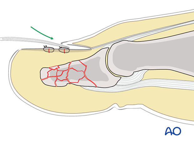 Reinsertion of the nail