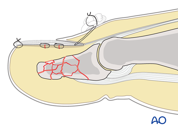 Suture inserted in the distal tip