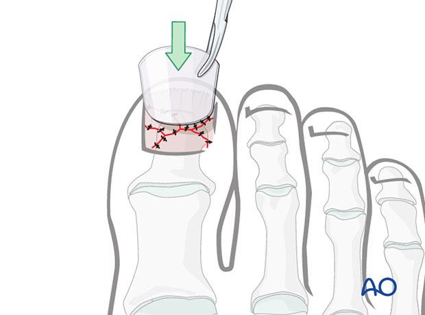 Fitting of the orthosis