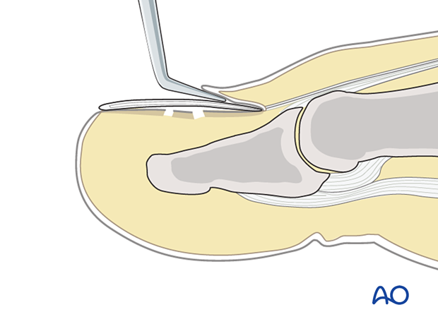 Freeing of the nail from the nail bed using blunt dissection up under the ungual fold