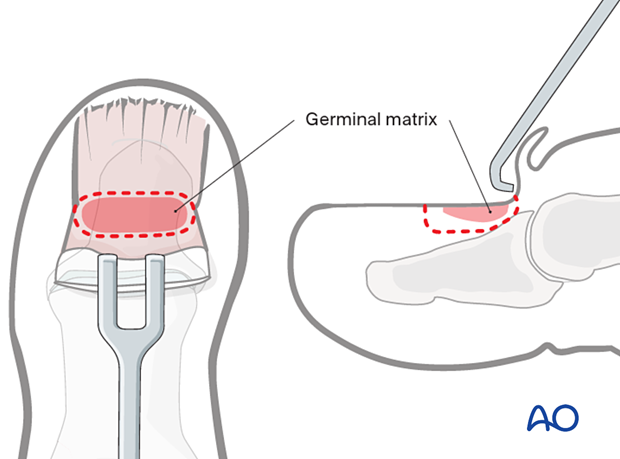 Outline of matricectomy 