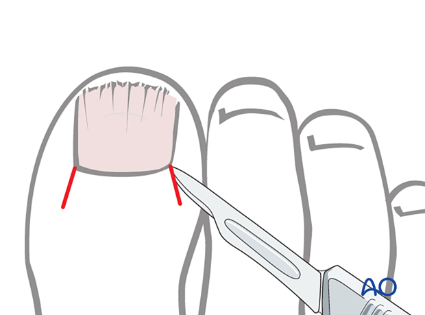 Medial and lateral incisions are made