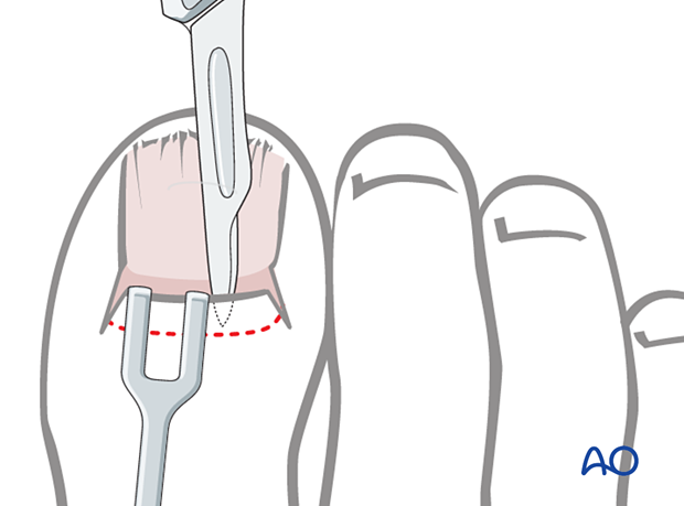 Separation of the ungual fold from the matrix
