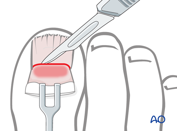 Distal transverse cut