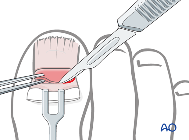 Proximal transverse cut