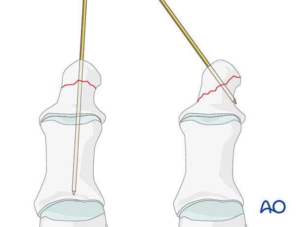 K-wire configurations (distal hallux)