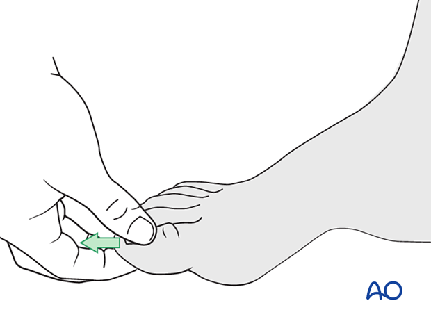 Grasp the digit's terminus and use a combination of axial and angular traction to exaggerate the deformity