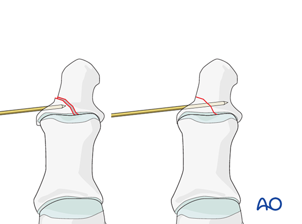 A K-wire can be inserted into the fragment and used as a joystick