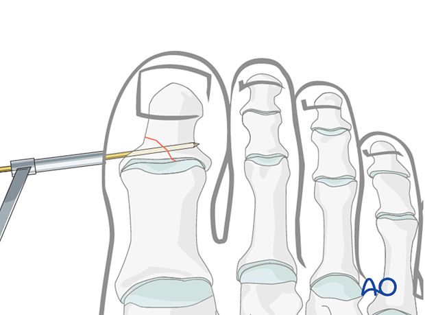 A K-wire is inserted percutaneously according to the preoperative plan