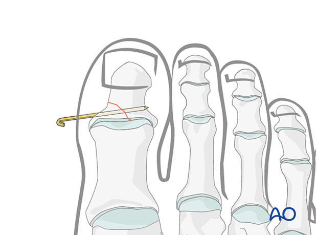 cut the K-wire leaving adequate K-wire protruding through the skin to facilitate removal