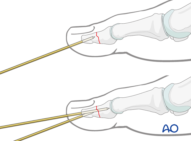 f a K-wire is mistakenly inserted at an angle to the phalanx axis, it is recommended to leave it in until a second K-wire has been inserted in the correct orientation