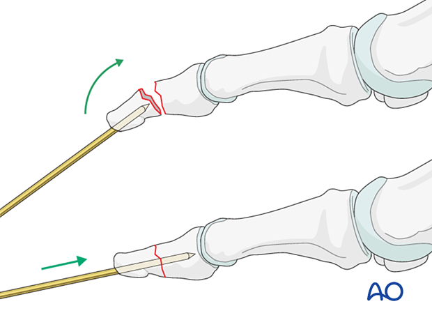 Use the K-wire as a joystick to reduce the fracture