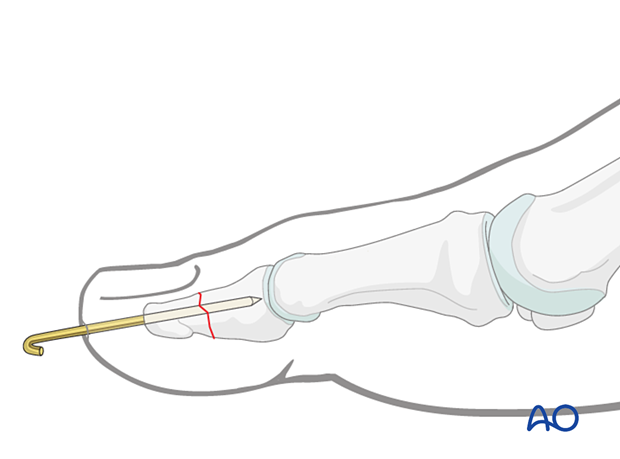 Cut the K-wire so that it protrudes through the skin, about 1 cm from the tip of the toe