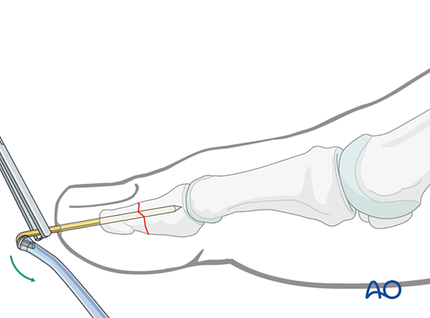 P101 K-wires