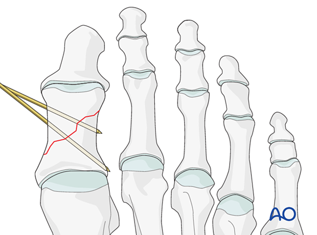 Diverging wires in simple oblique fractures