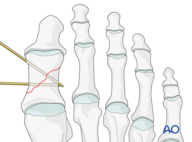 Crossing wires in simple oblique fractures