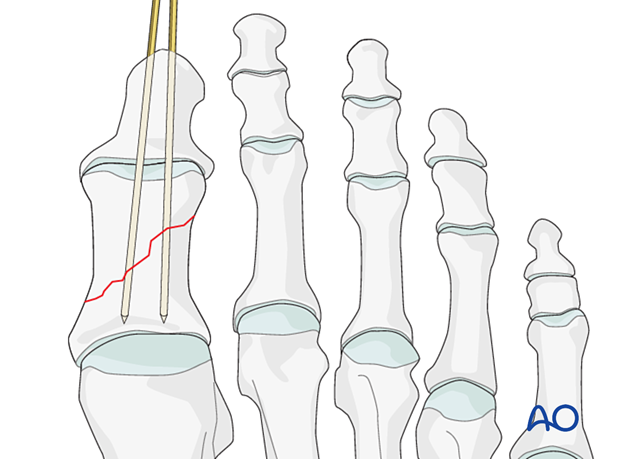 Axial wires in simple oblique fractures