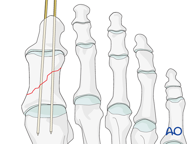 K-wire may also be inserted to cross the MTP joint if needed. 