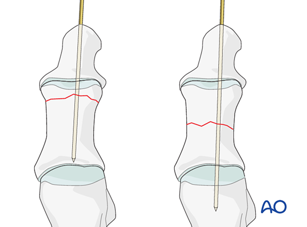 Axial wires in simple transverse fractures