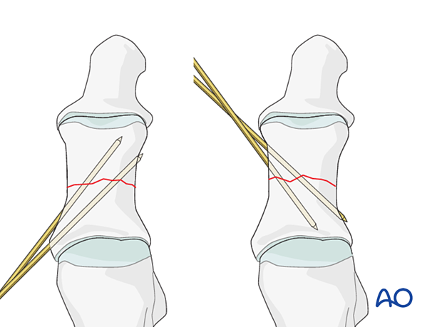 Medial wires in simple transverse fractures