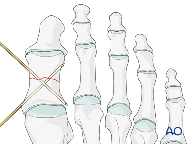 Crossing wires in simple transverse fractures