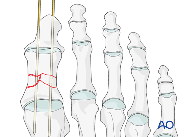 Axial wires in multifragmentary fractures