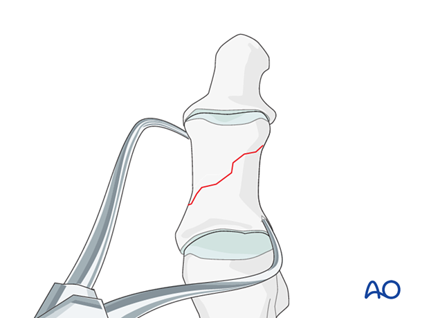 Reduction and preliminary fixation using a reduction clamp