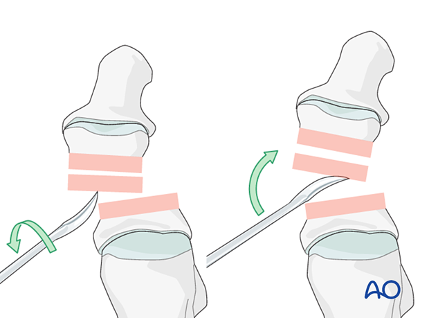 Reduction and preliminary fixation using a periosteal elevator