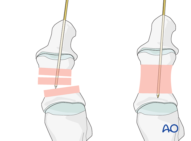 Reduction and preliminary fixation using K-wire as joystick